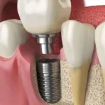 Dental Implants Leichhardt: A Complete Guide to Restoring Missing Teeth with Modern Implant Dentistry