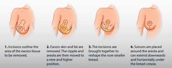 Breast Reduction Surgery in Islamabad