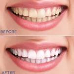 Wisdom Teeth Removal Newtown: A Complete Guide to Safe and Effective Wisdom Tooth Treatment