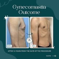 gynecomastia in islamabad